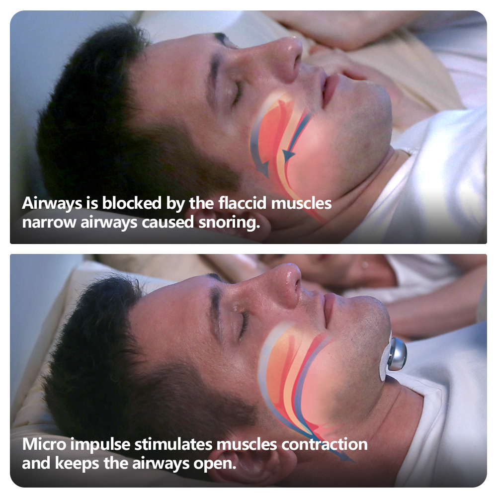 Snore Circle YA4300 Electronic Muscle Stimulator Pro With A Pack of Conductive Strips