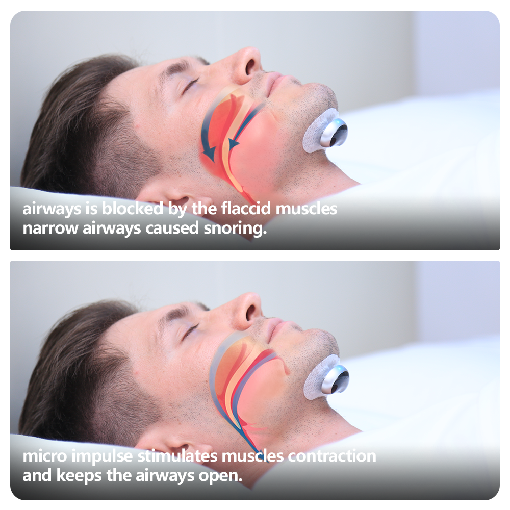 Snore Circle YA4200 Electronic Muscle Stimulator Plus With A Pack of Conductive Strips